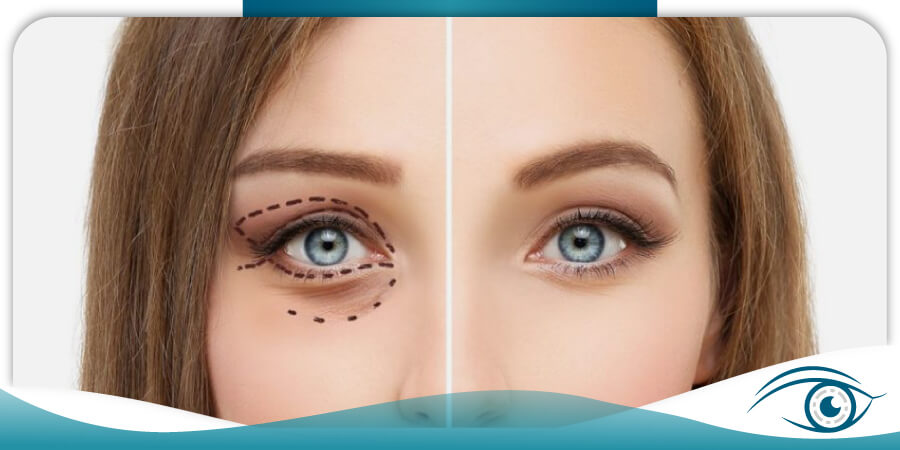 INSTITUTO-DE-LA-VISION-AC-CLINICA-OFTALMOLOGICA--cirugia-de-parpados