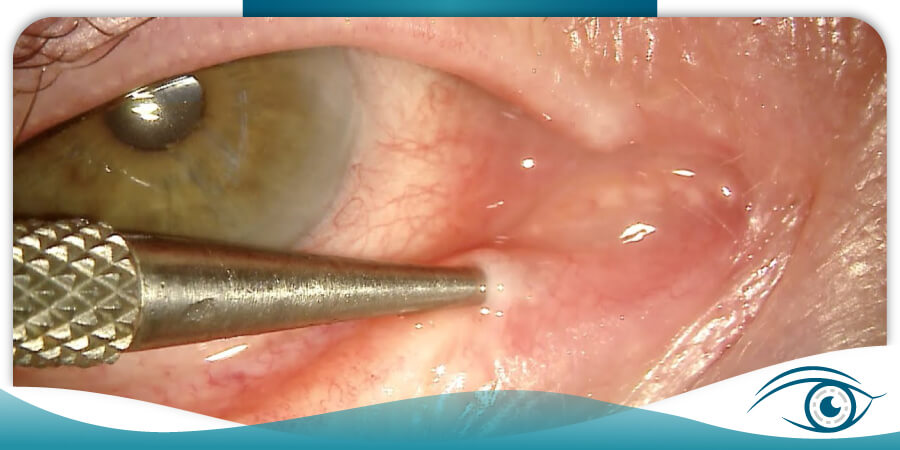 INSTITUTO-DE-LA-VISION-AC-CLINICA-OFTALMOLOGICA--sondaje-de-via-lagrimal